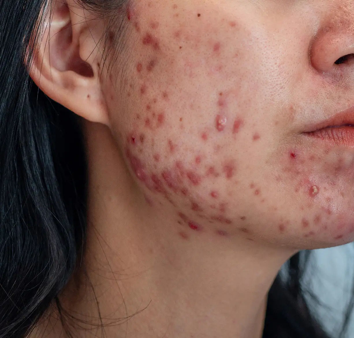Acne