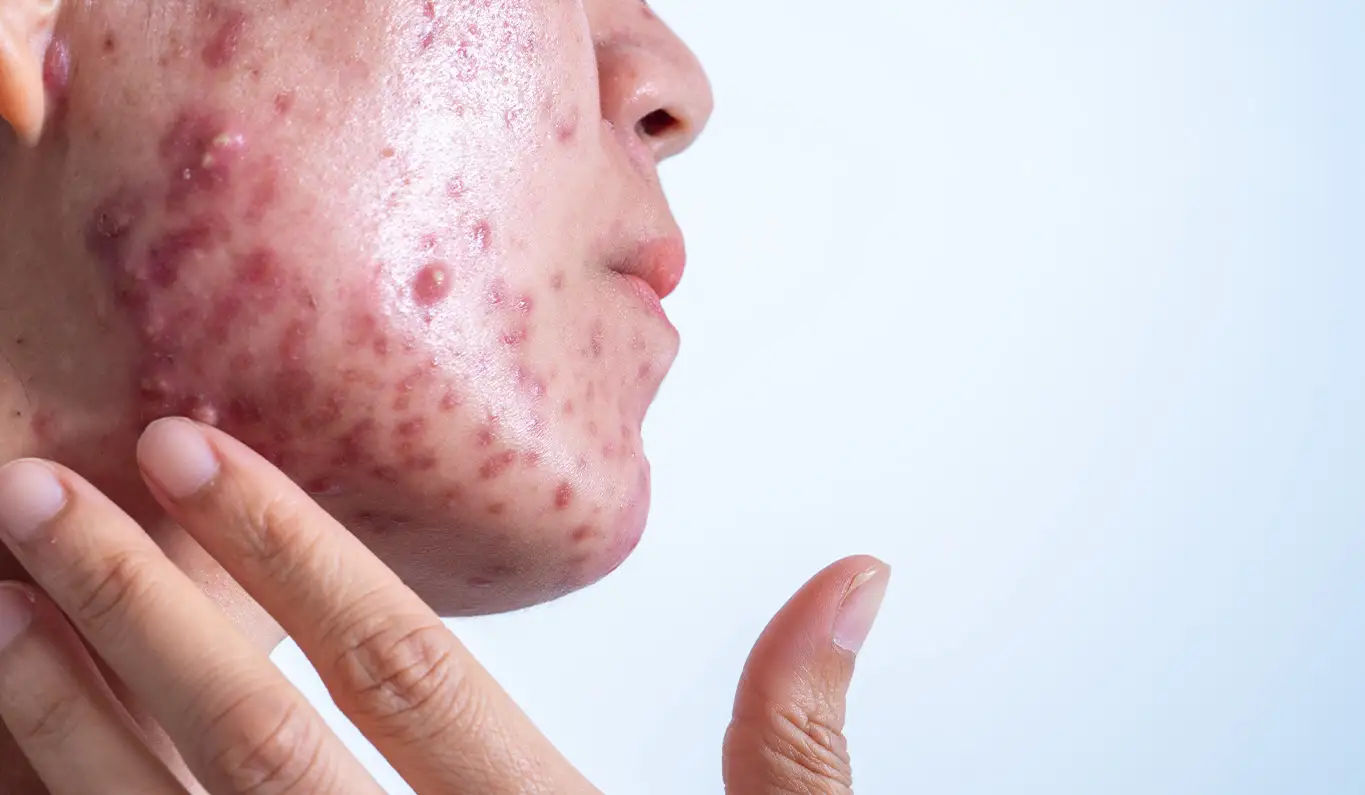 Acne
