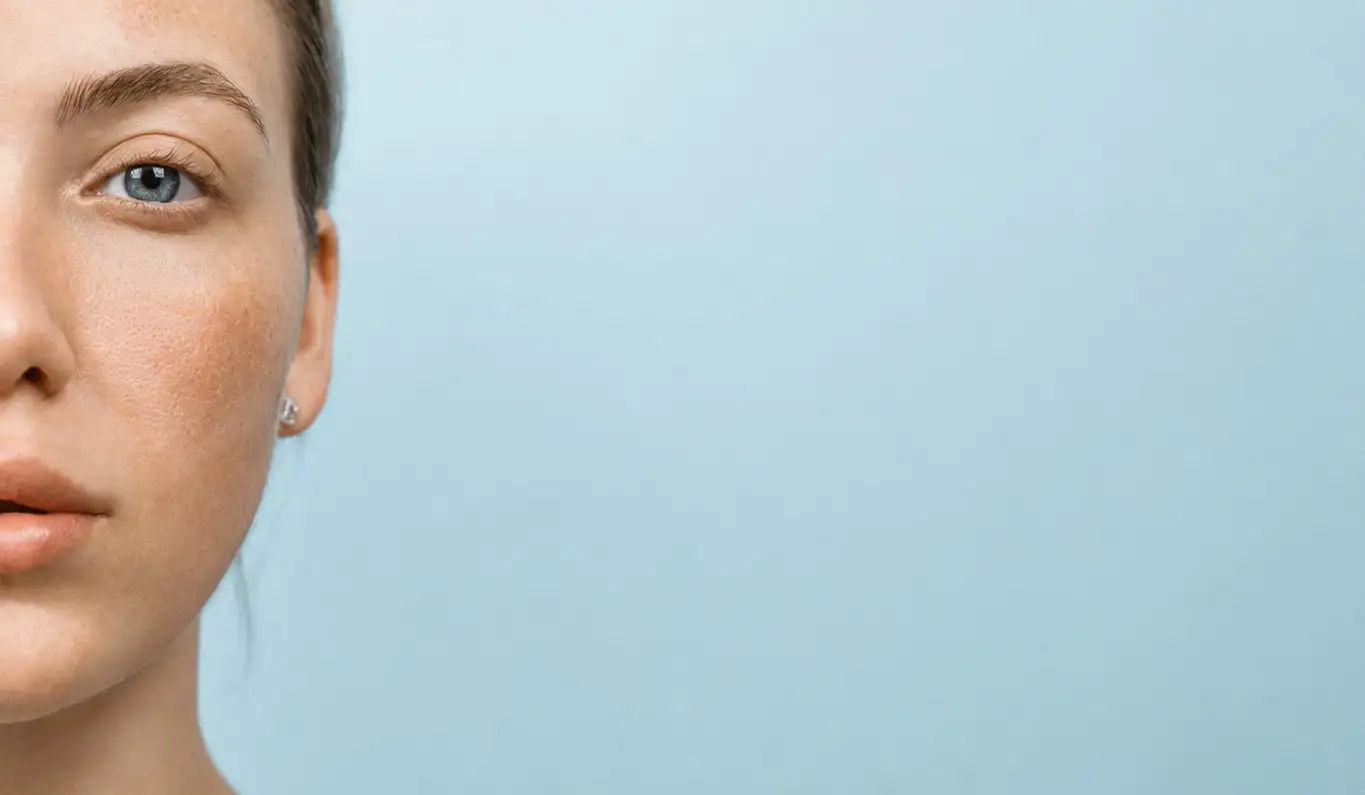 Melasma e manchas
