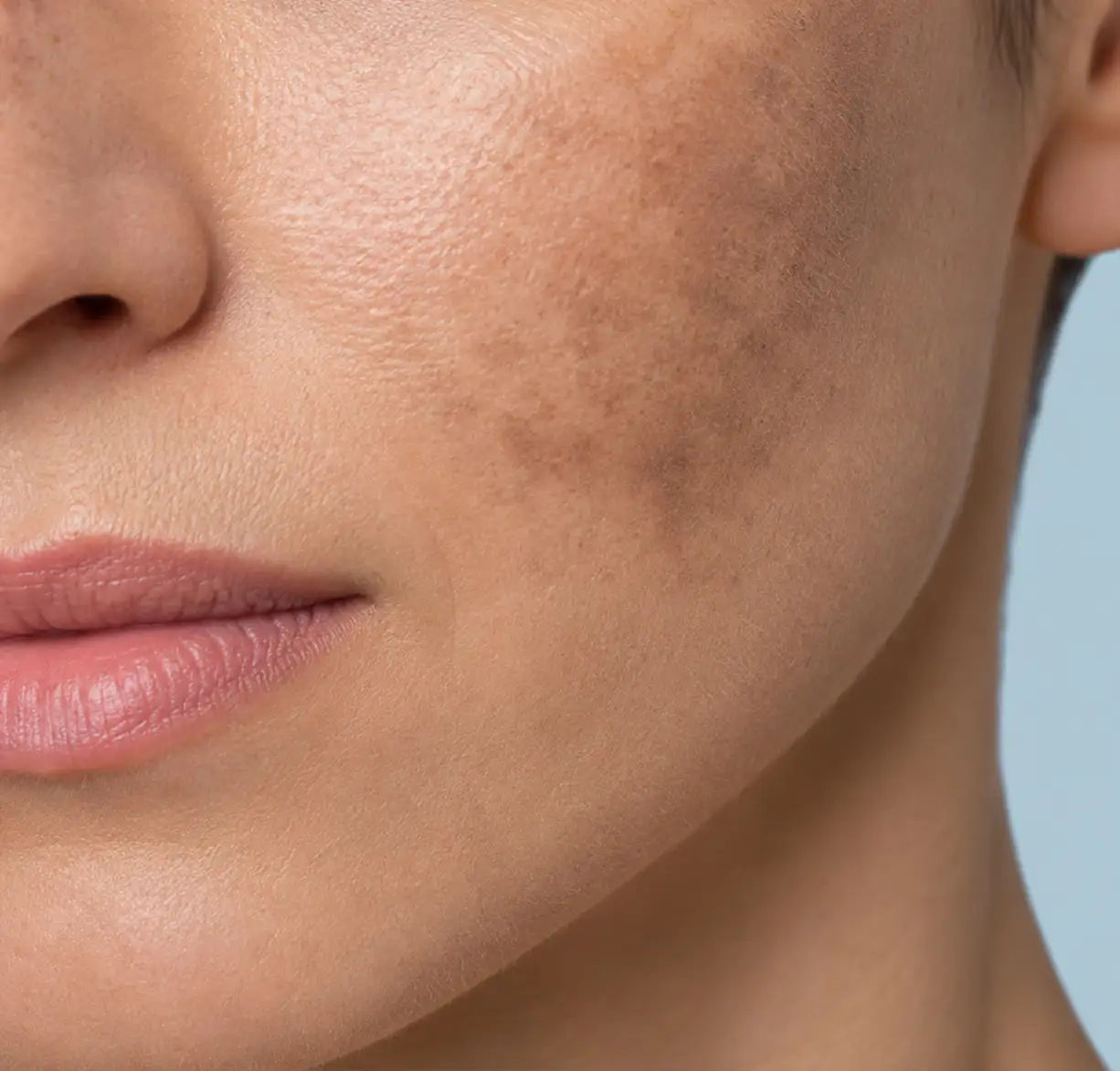 Melasma e Manchas