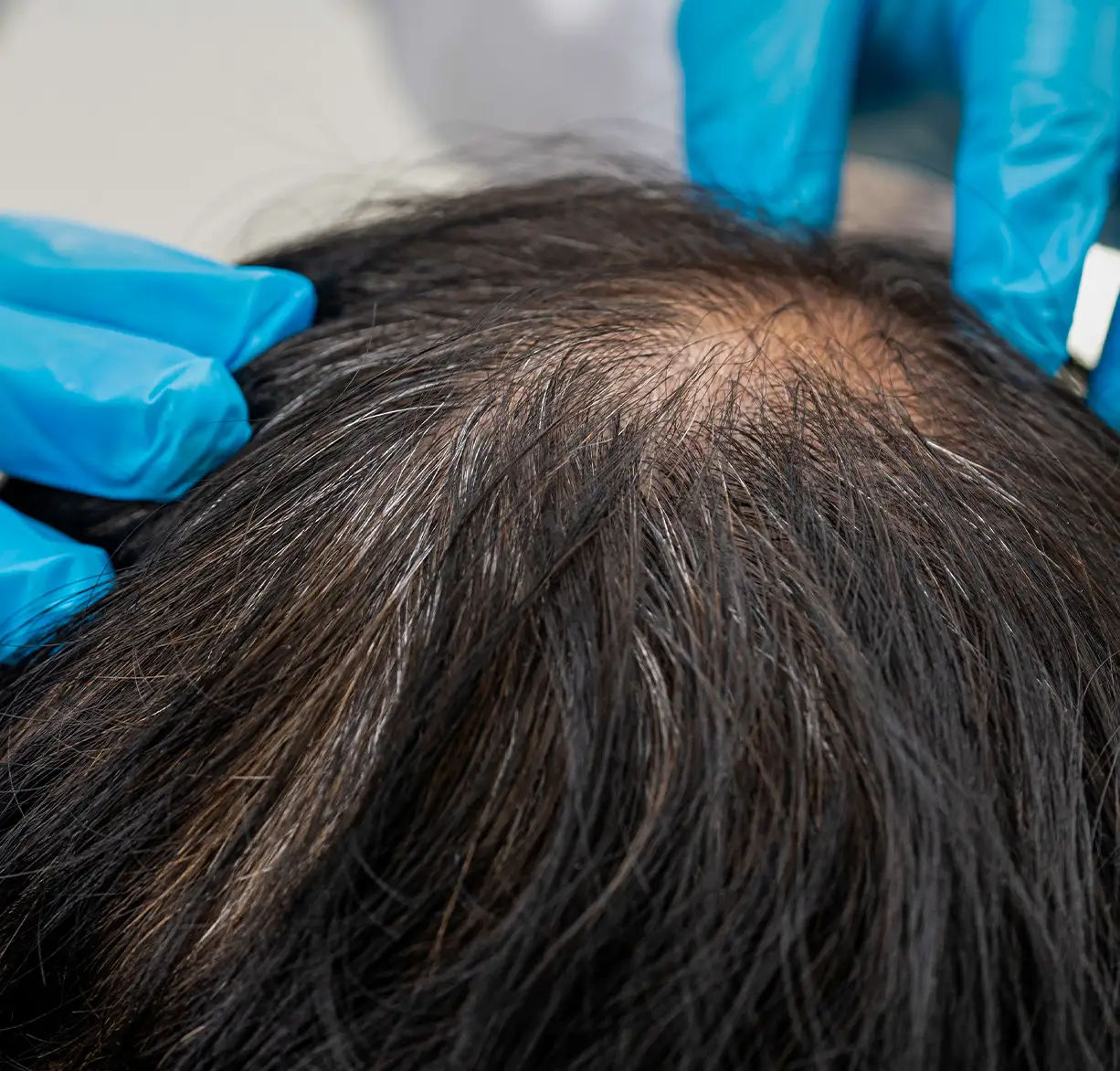 Alopecias